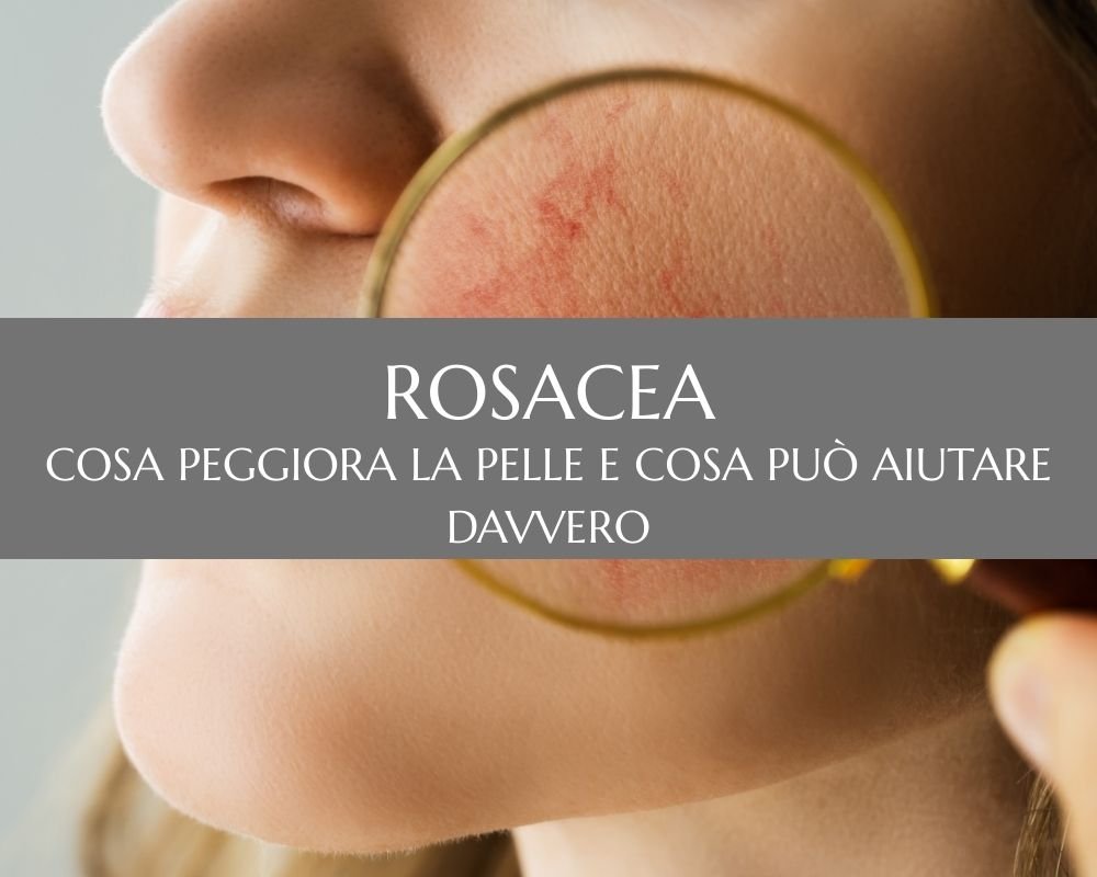 Rosacea