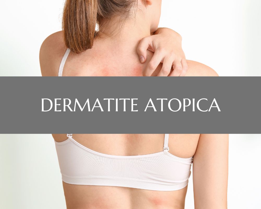 Dermatite atopica