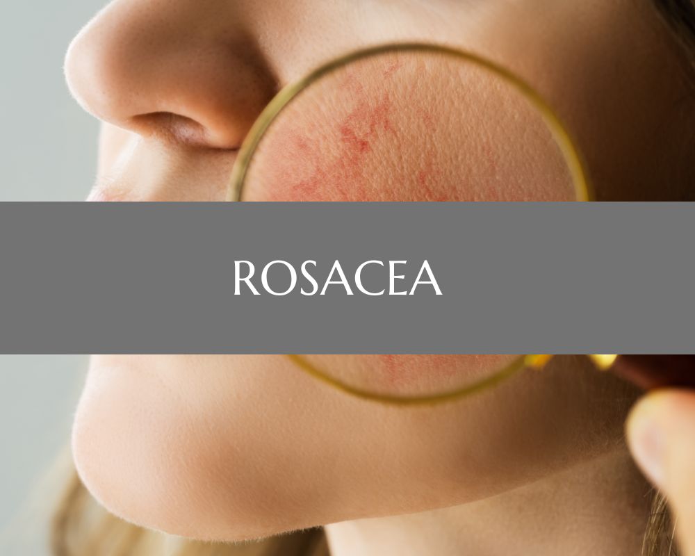 Rosacea